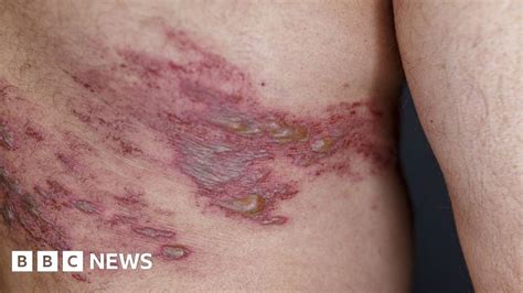 An individual filed suit on Wednesday in the Eastern District of. . Side effects of the shingles vaccine
